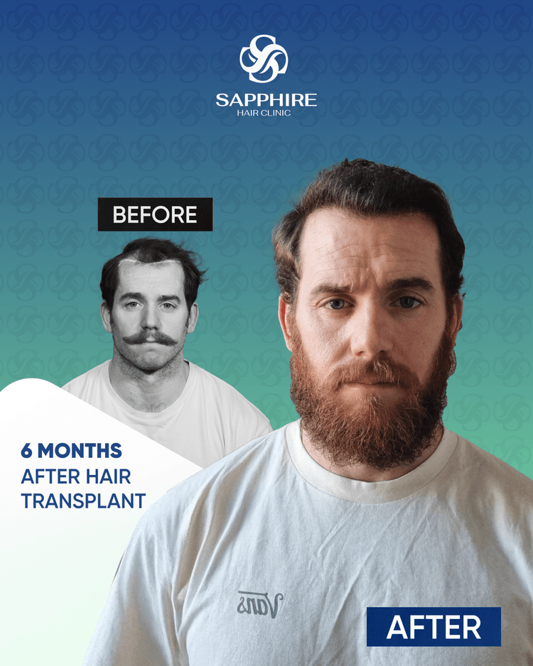 Before After 1