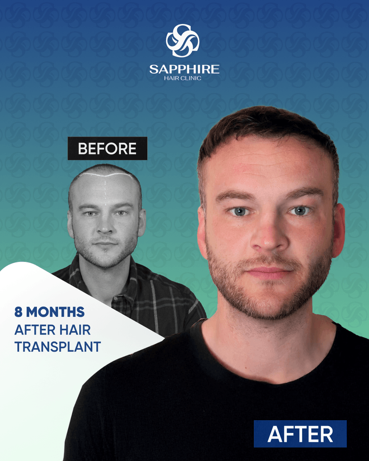 Before After 2