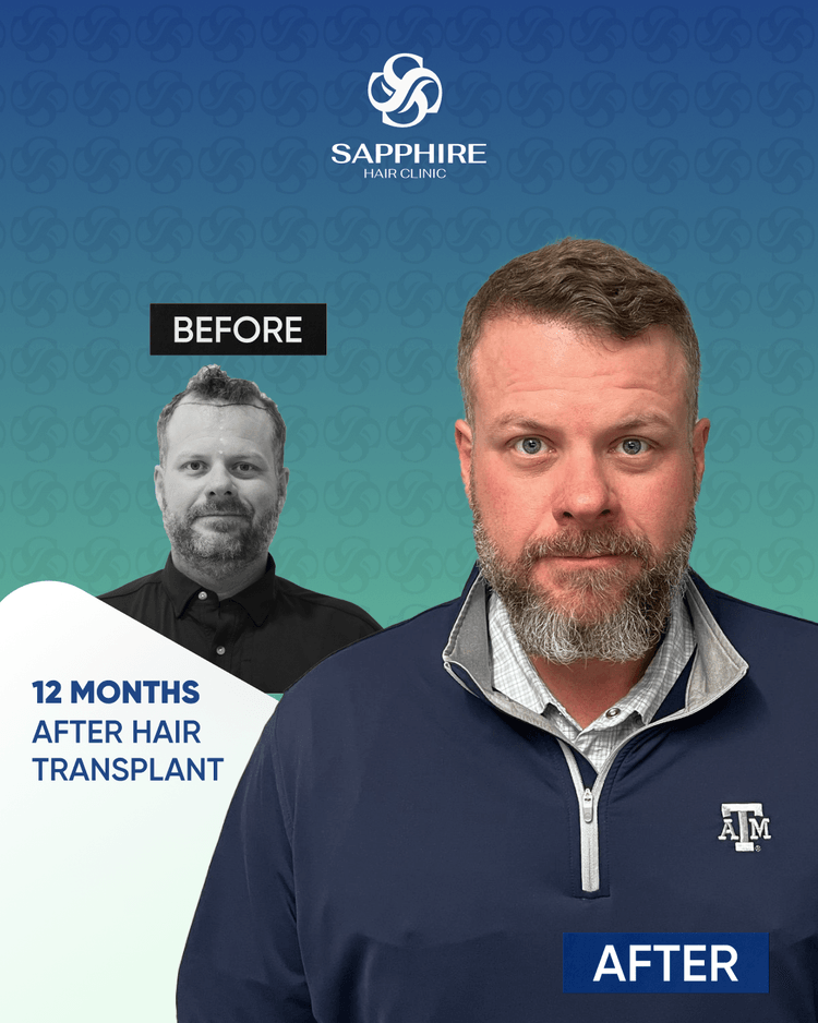 Before After 4