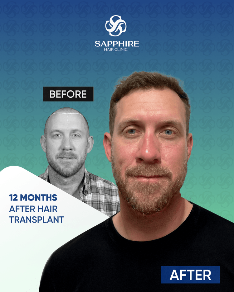 Before After 5