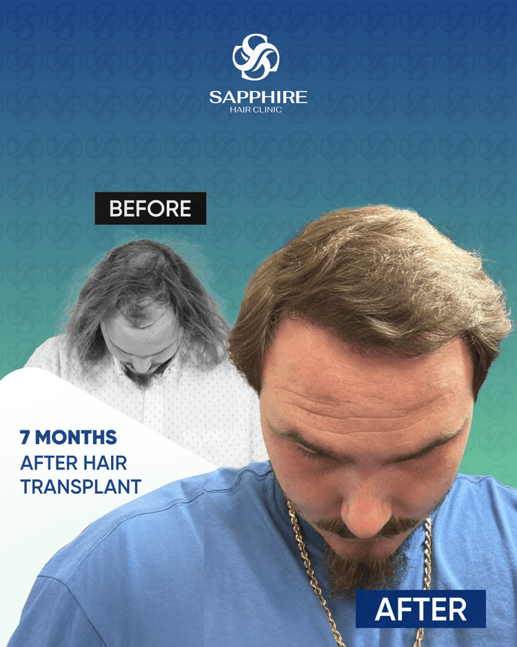 Before After 6