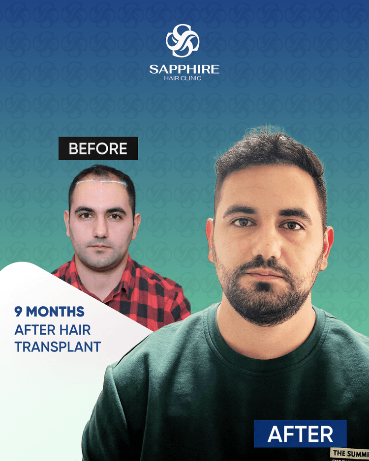 Before After 7